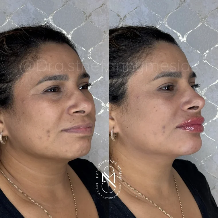 Resultado antes y después de un tratamiento con ácido hialurónico realizado por la Dra. Sthefanny Mesías en Cali, caso 4