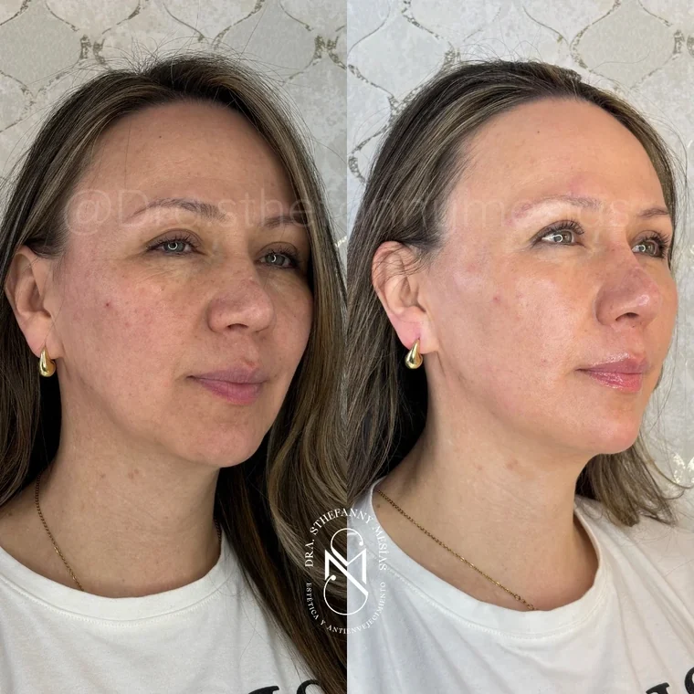 Before and after facial harmonization performed by Dr. Sthefanny Mesías in Cali, Colombia — case 2