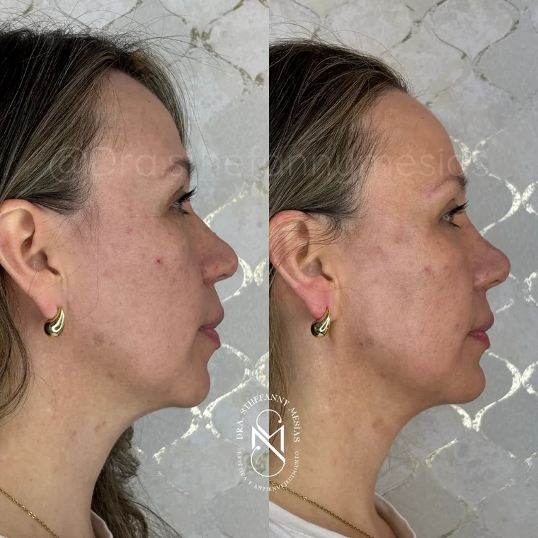 Before and after facial harmonization performed by Dr. Sthefanny Mesías in Cali, Colombia — case 3
