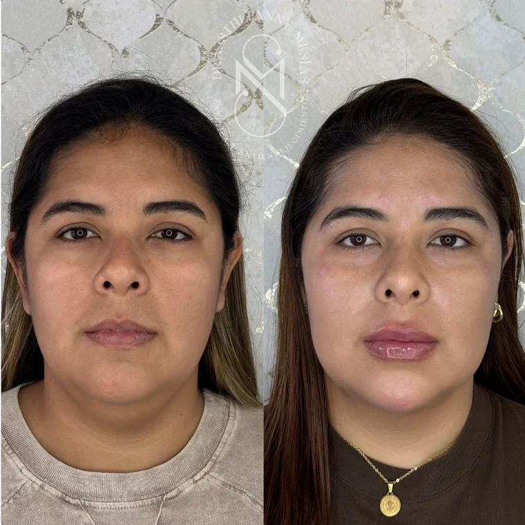 Resultado antes y después de una bichectomía realizada por la Dra. Sthefanny Mesías en Cali, caso 1