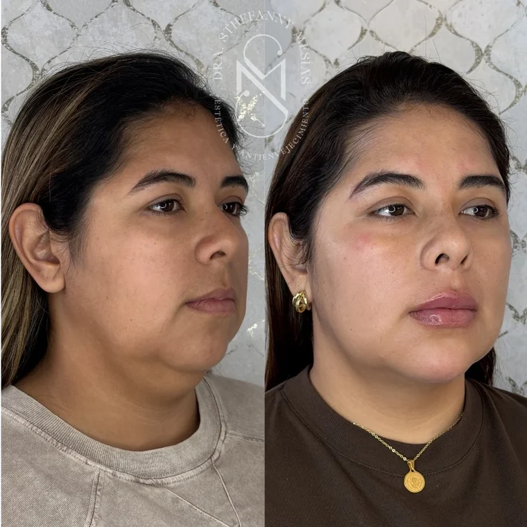 Resultado antes y después de una bichectomía realizada por la Dra. Sthefanny Mesías en Cali, caso 2