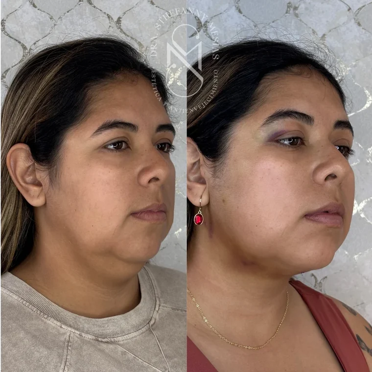 Resultado antes y después de una bichectomía realizada por la Dra. Sthefanny Mesías en Cali, caso 3