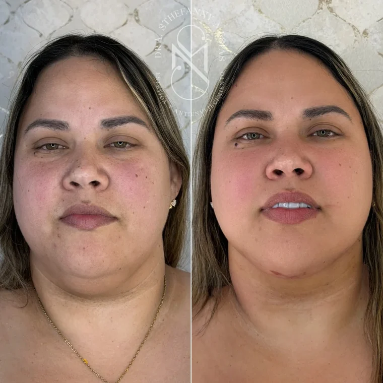 Resultado antes y después de una bichectomía realizada por la Dra. Sthefanny Mesías en Cali, caso 4
