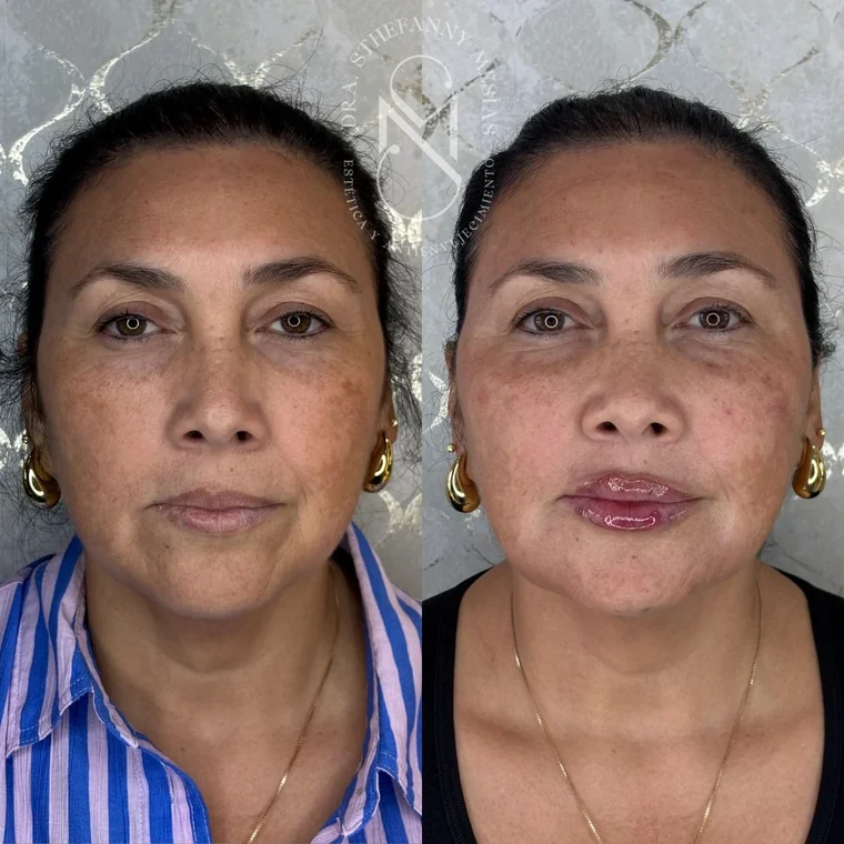 Before and after collagen biostimulation performed by Dr. Sthefanny Mesías in Cali, Colombia — case 1