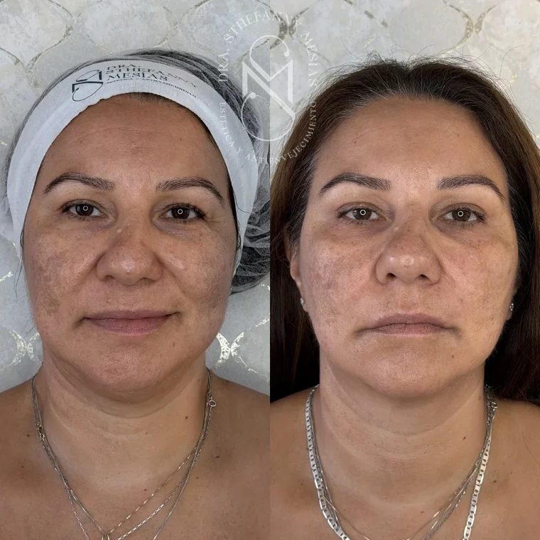 Before and after collagen biostimulation performed by Dr. Sthefanny Mesías in Cali, Colombia — case 2
