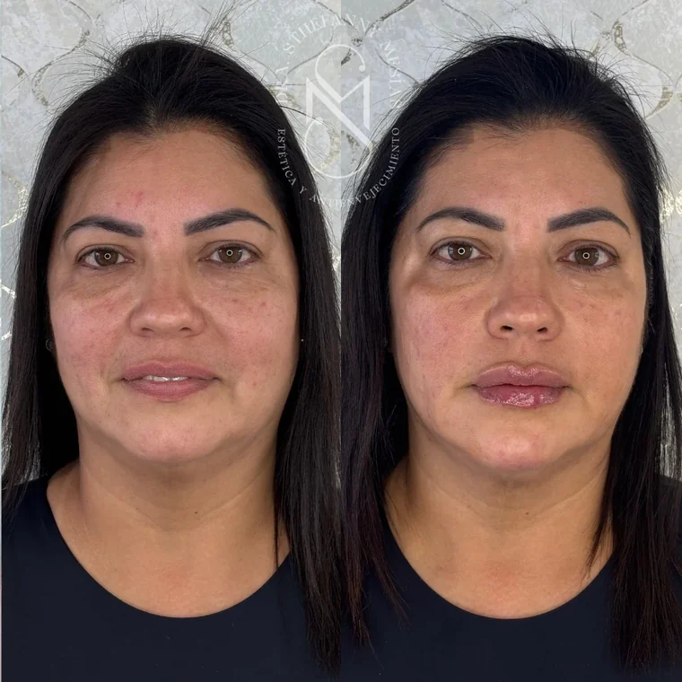 Before and after collagen biostimulation performed by Dr. Sthefanny Mesías in Cali, Colombia — case 5