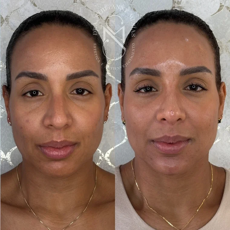 Before and after collagen biostimulation performed by Dr. Sthefanny Mesías in Cali, Colombia — case 6