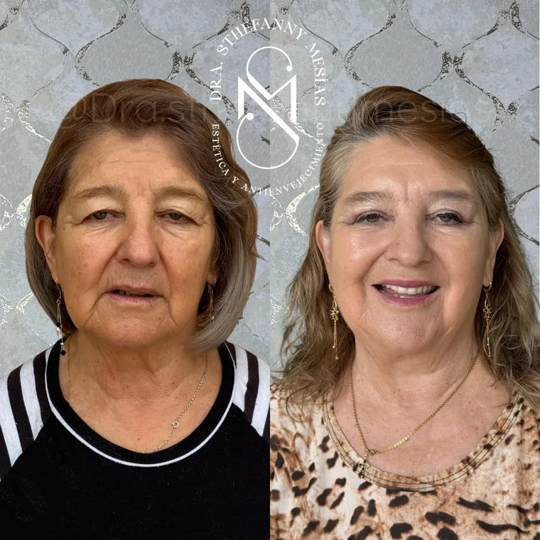 Resultado antes y después de una blefaroplastia realizada por la Dra. Sthefanny Mesías en Cali, caso 1