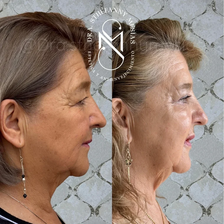 Resultado antes y después de una blefaroplastia realizada por la Dra. Sthefanny Mesías en Cali, caso 2