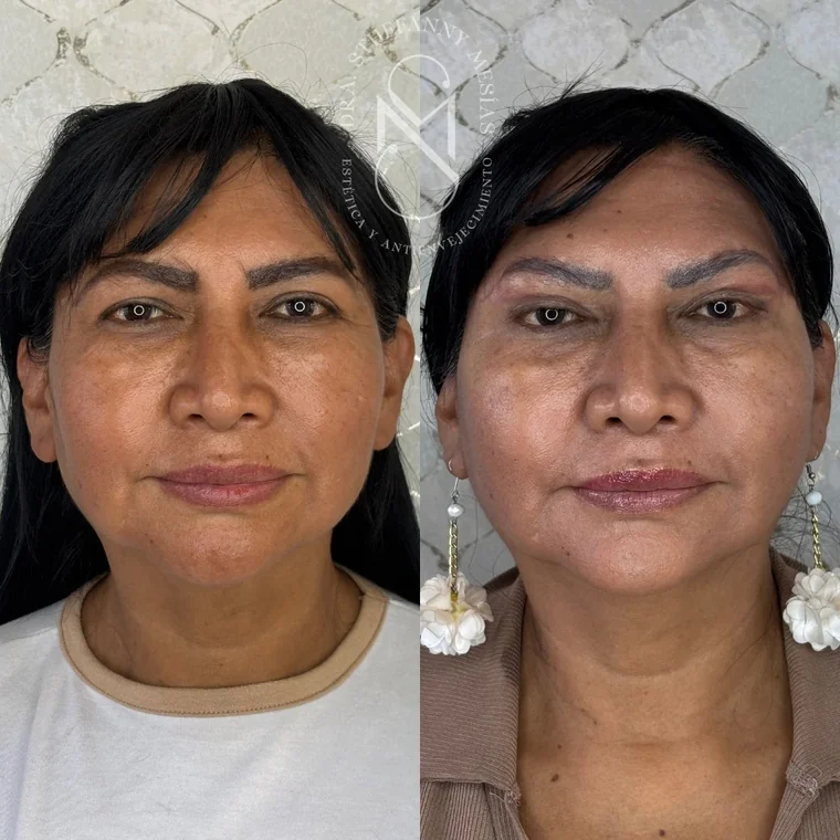 Resultado antes y después de una blefaroplastia realizada por la Dra. Sthefanny Mesías en Cali, caso 3