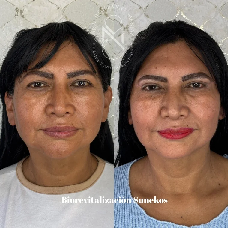 Resultado antes y después de una blefaroplastia realizada por la Dra. Sthefanny Mesías en Cali, caso 4