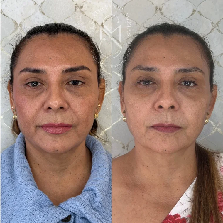 Resultado antes y después de un endolifting láser realizado por la Dra. Sthefanny Mesías en Cali, caso 1