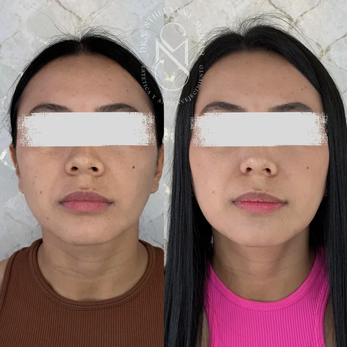 Resultado antes y después de alectomía realizado por la Dra. Sthefanny Mesías en Cali