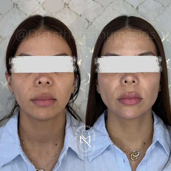 Resultado antes y después de una armonización facial realizada en Cali por la Dra. Sthefanny Mesías