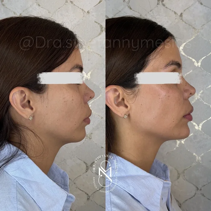 Resultado antes y después de armonización facial realizado por la Dra. Sthefanny Mesías en Cali
