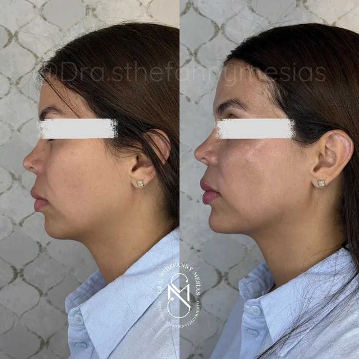 Resultado antes y después de armonización facial realizado por la Dra. Sthefanny Mesías en Cali