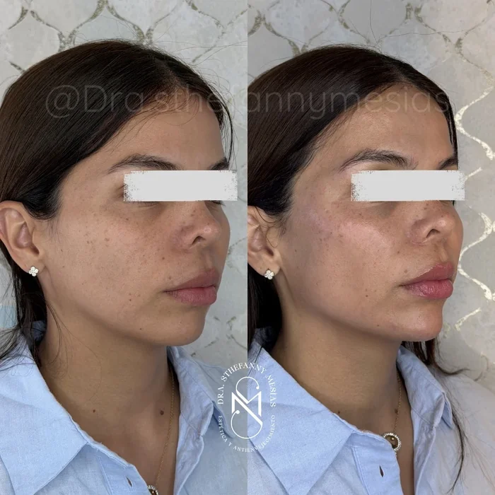 Resultado antes y después de armonización facial realizado por la Dra. Sthefanny Mesías en Cali