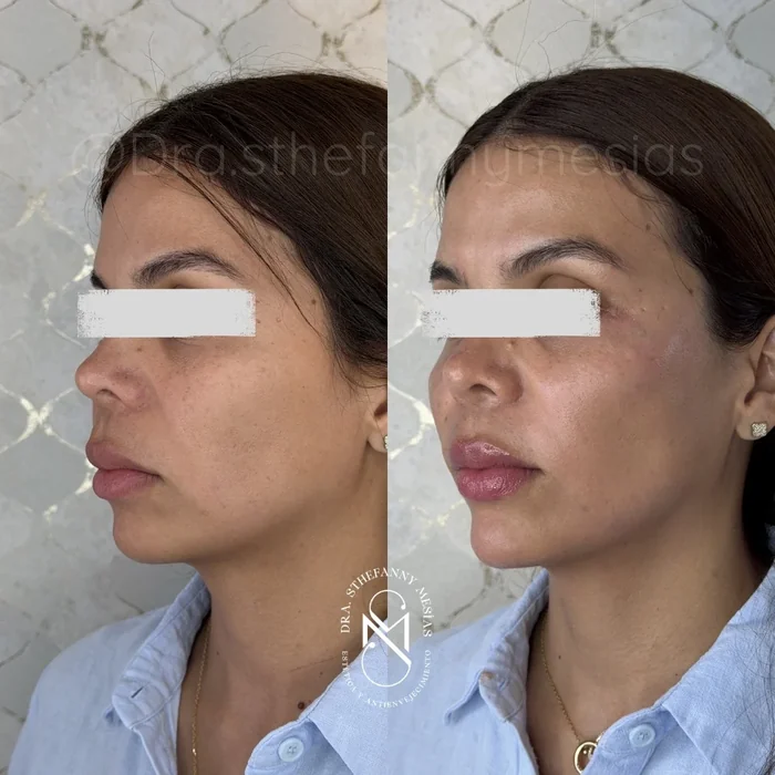 Resultado antes y después de armonización facial realizado por la Dra. Sthefanny Mesías en Cali