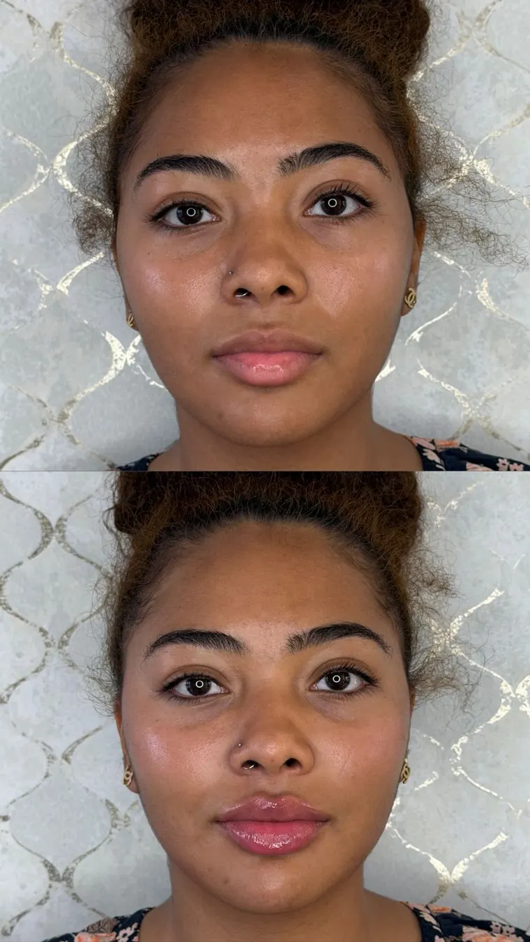 Resultado antes y después de armonización facial realizado por la Dra. Sthefanny Mesías en Cali