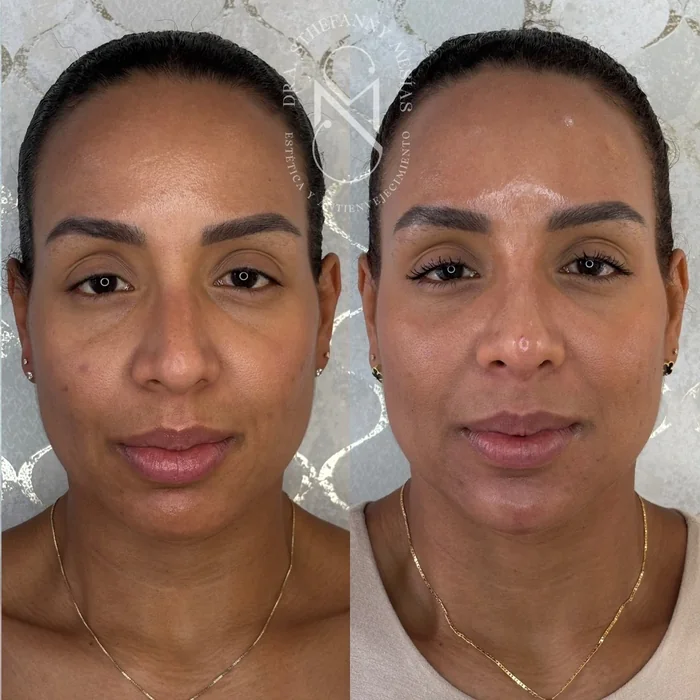 Resultado antes y después de tratamiento con bioestimuladores de colágeno realizado por la Dra. Sthefanny Mesías en Cali