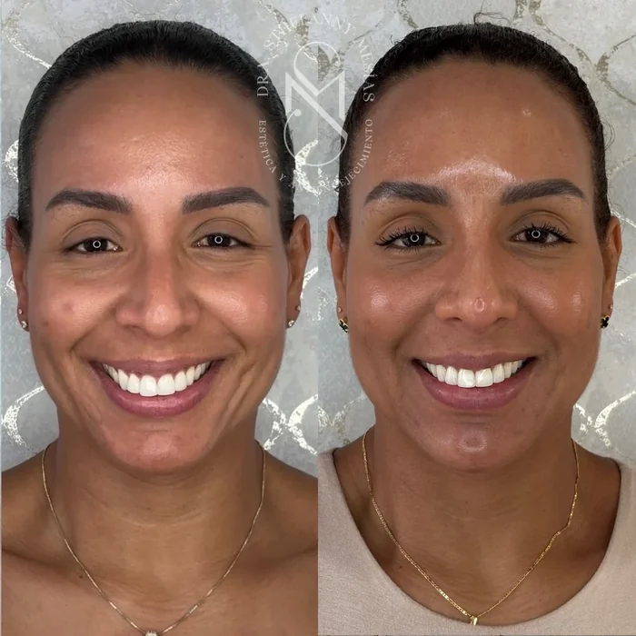 Resultado antes y después de tratamiento con bioestimuladores de colágeno realizado por la Dra. Sthefanny Mesías en Cali