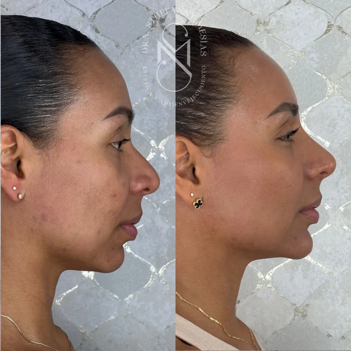 Resultado antes y después de tratamiento con bioestimuladores de colágeno realizado por la Dra. Sthefanny Mesías en Cali