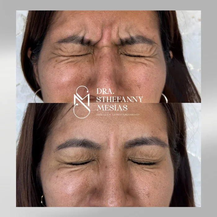 Resultado antes y después de aplicación de toxina botulínica realizado por la Dra. Sthefanny Mesías en Cali