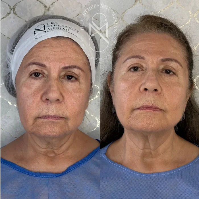 Resultado antes y después de endolifting realizado por la Dra. Sthefanny Mesías en Cali