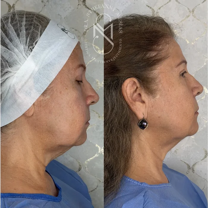Resultado antes y después de endolifting realizado por la Dra. Sthefanny Mesías en Cali