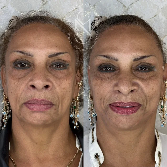 Resultado antes y después de lifting facial con hilos PDO realizado por la Dra. Sthefanny Mesías en Cali