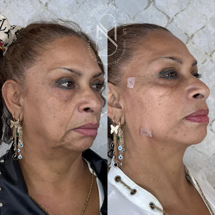 Resultado antes y después de lifting facial con hilos PDO realizado por la Dra. Sthefanny Mesías en Cali