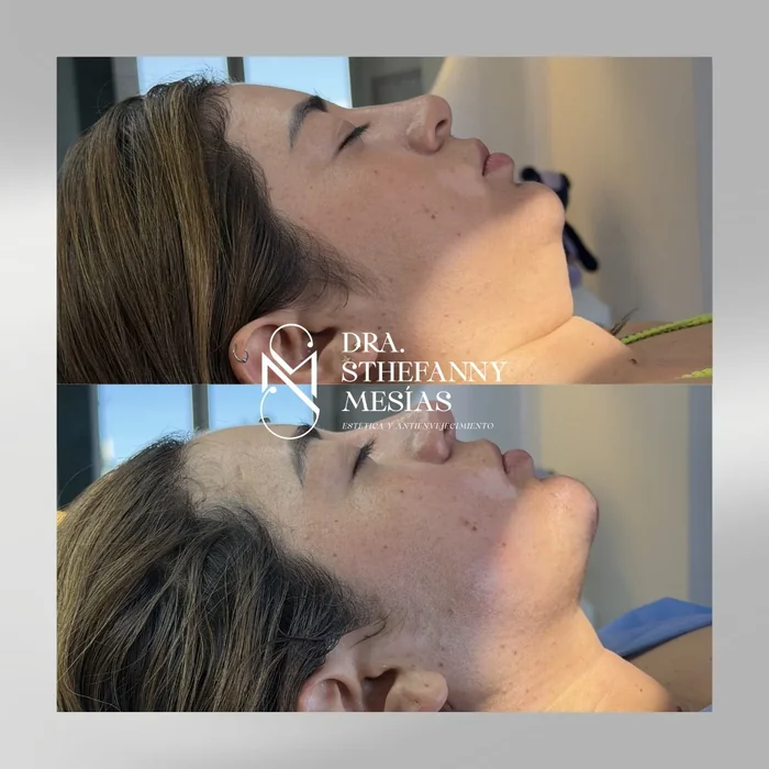 Resultado antes y después de eliminación de lipopapada realizado por la Dra. Sthefanny Mesías en Cali