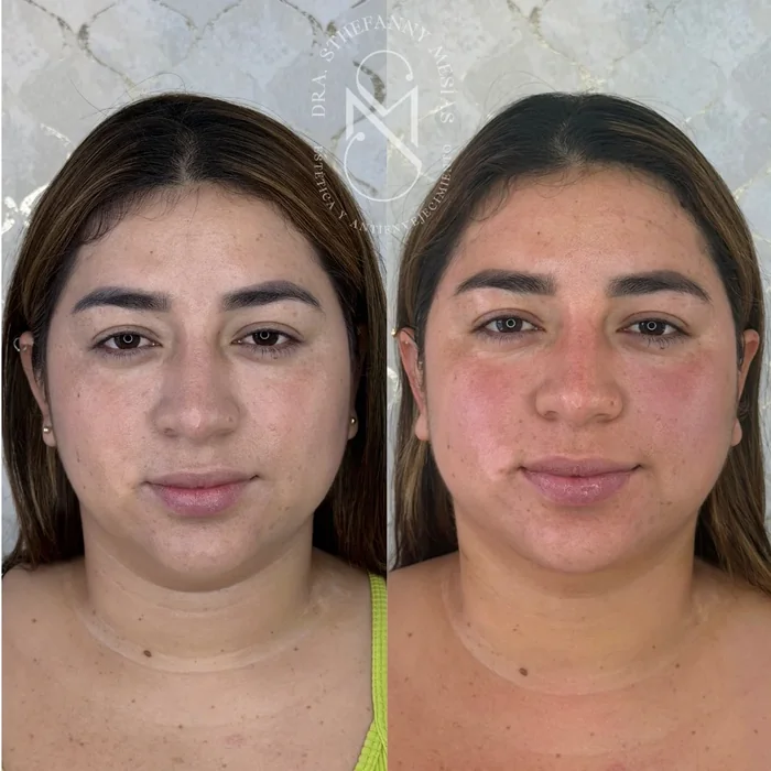 Resultado antes y después de eliminación de lipopapada realizado por la Dra. Sthefanny Mesías en Cali