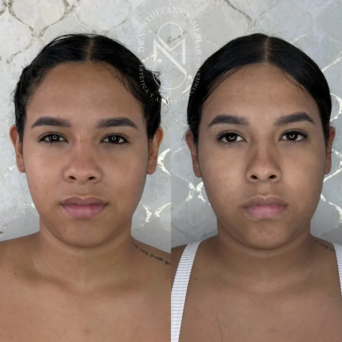 Resultado antes y después de otoplastia realizado por la Dra. Sthefanny Mesías en Cali