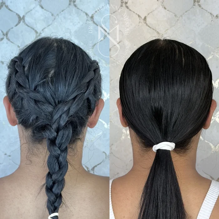 Resultado antes y después de otoplastia realizado por la Dra. Sthefanny Mesías en Cali