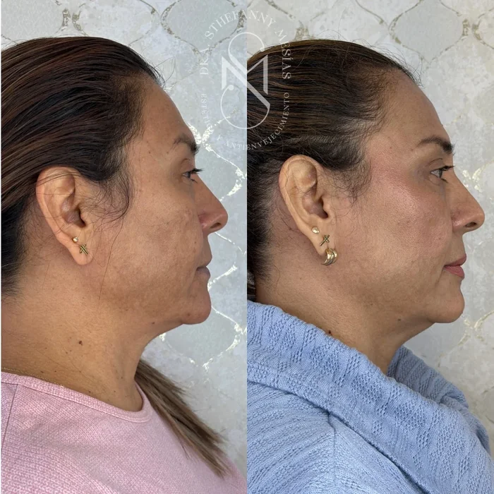 Resultado antes y después de peeling facial realizado por la Dra. Sthefanny Mesías en Cali