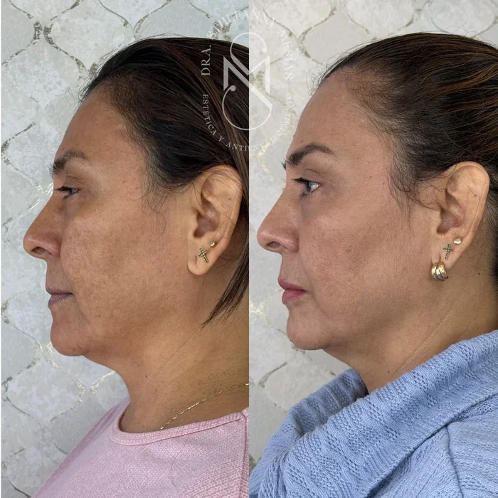 Resultado antes y después de peeling facial realizado por la Dra. Sthefanny Mesías en Cali