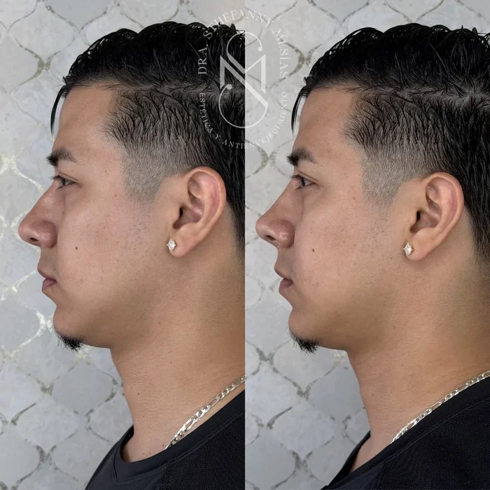 Resultado antes y después de rinomodelación realizado por la Dra. Sthefanny Mesías en Cali
