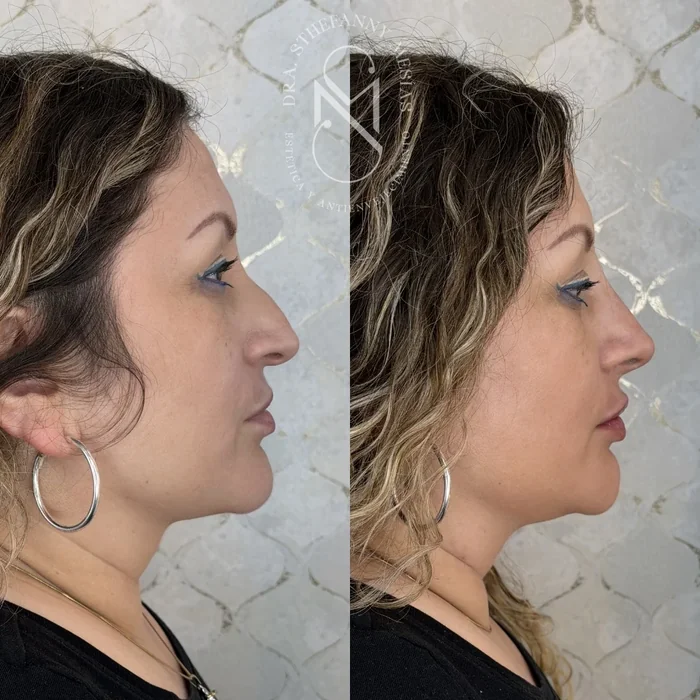 Resultado antes y después de rinomodelación realizado por la Dra. Sthefanny Mesías en Cali