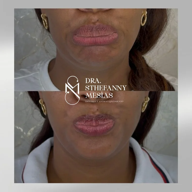 Resultado antes y después de un tratamiento de sonrisa gingival con toxina botulínica realizado por la Dra. Sthefanny Mesías en Cali, caso 1