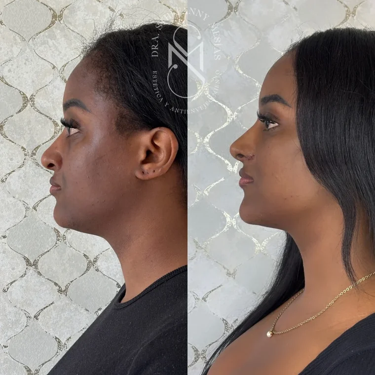Resultado antes y después de un lifting facial con hilos tensores realizado por la Dra. Sthefanny Mesías en Cali, caso 1