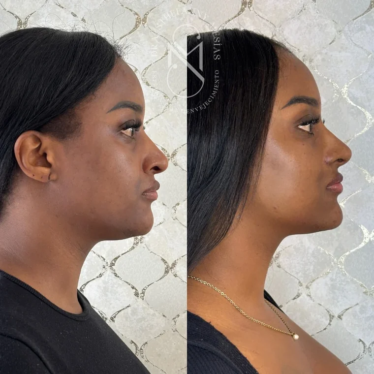 Resultado antes y después de un lifting facial con hilos tensores realizado por la Dra. Sthefanny Mesías en Cali, caso 2