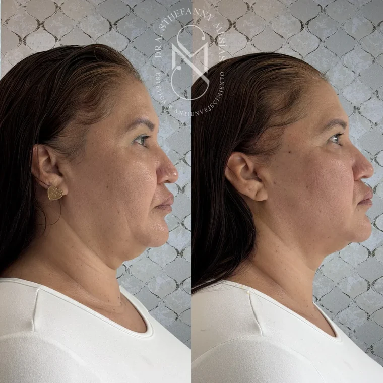 Resultado antes y después de un lifting facial con hilos tensores realizado por la Dra. Sthefanny Mesías en Cali, caso 3