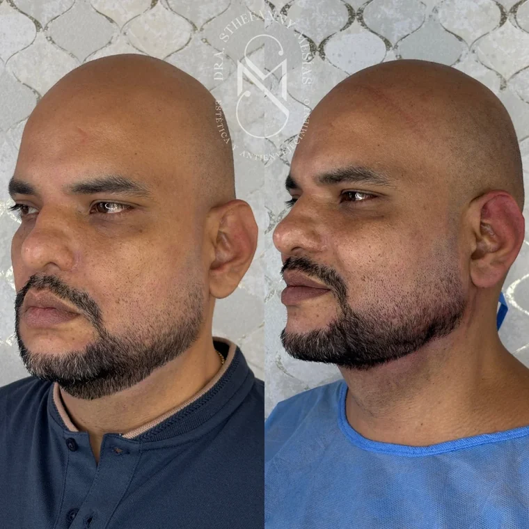 Resultado antes y después de un lifting facial con hilos tensores realizado por la Dra. Sthefanny Mesías en Cali, caso 4