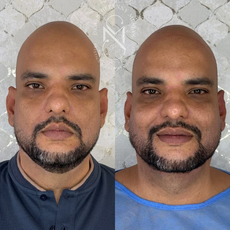 Resultado antes y después de un lifting facial con hilos tensores realizado por la Dra. Sthefanny Mesías en Cali, caso 5