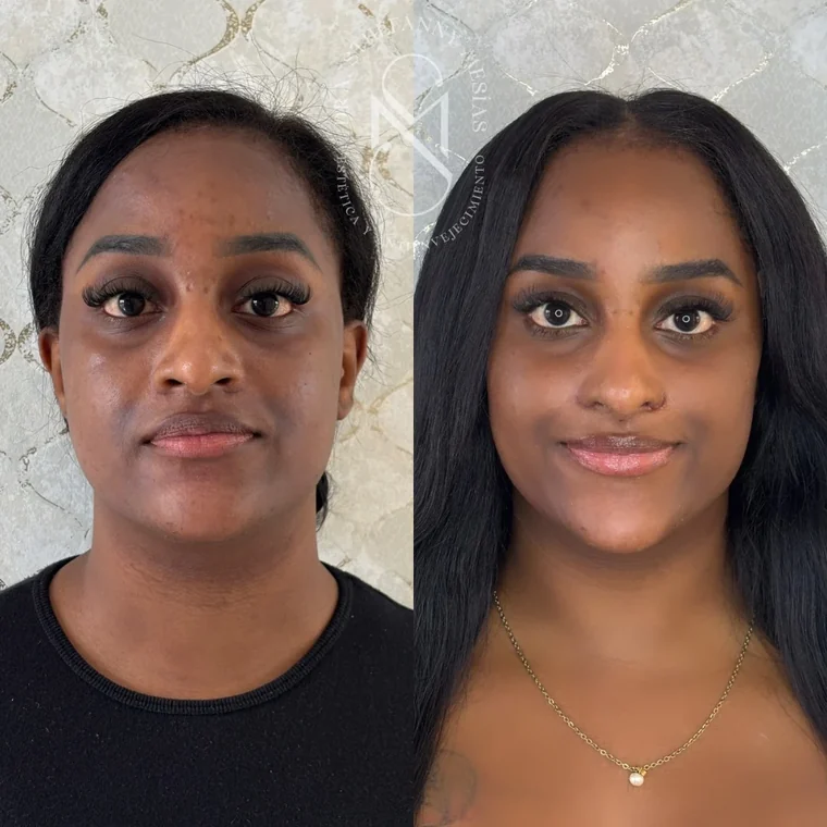 Resultado antes y después de un lifting facial con hilos tensores realizado por la Dra. Sthefanny Mesías en Cali, caso 6