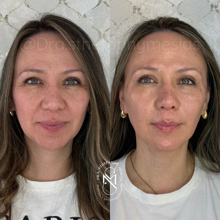 Resultado antes y después de un diseño de labios con ácido hialurónico realizado en Cali por la Dra. Sthefanny Mesías, caso 3