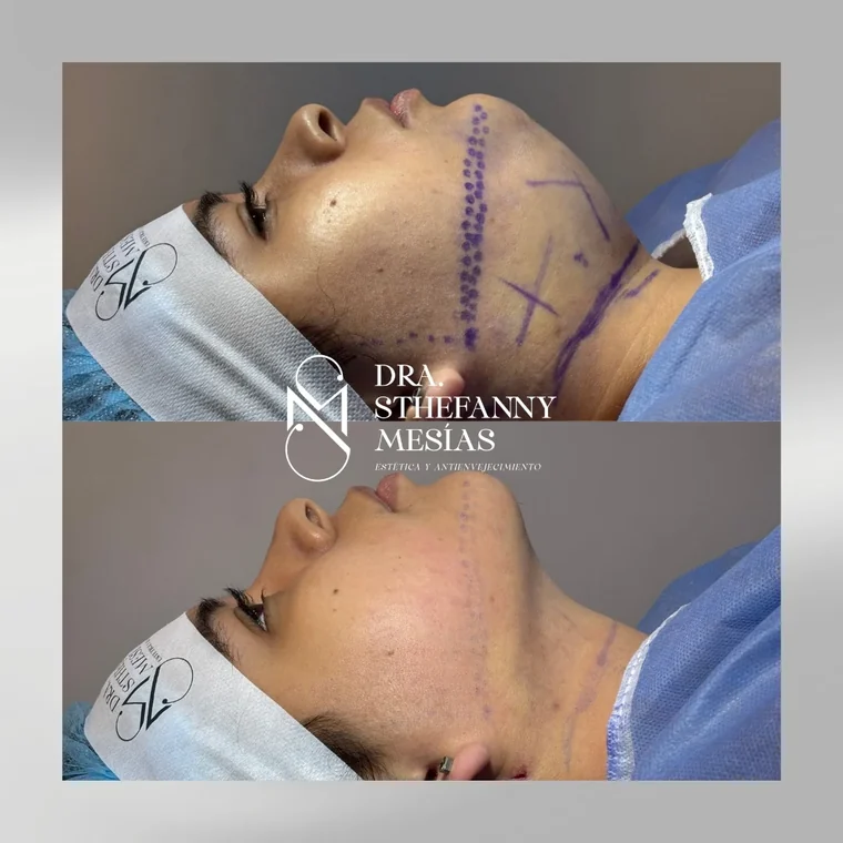 Resultado antes y después de una eliminación de lipopapada realizada por la Dra. Sthefanny Mesías en Cali, caso 1