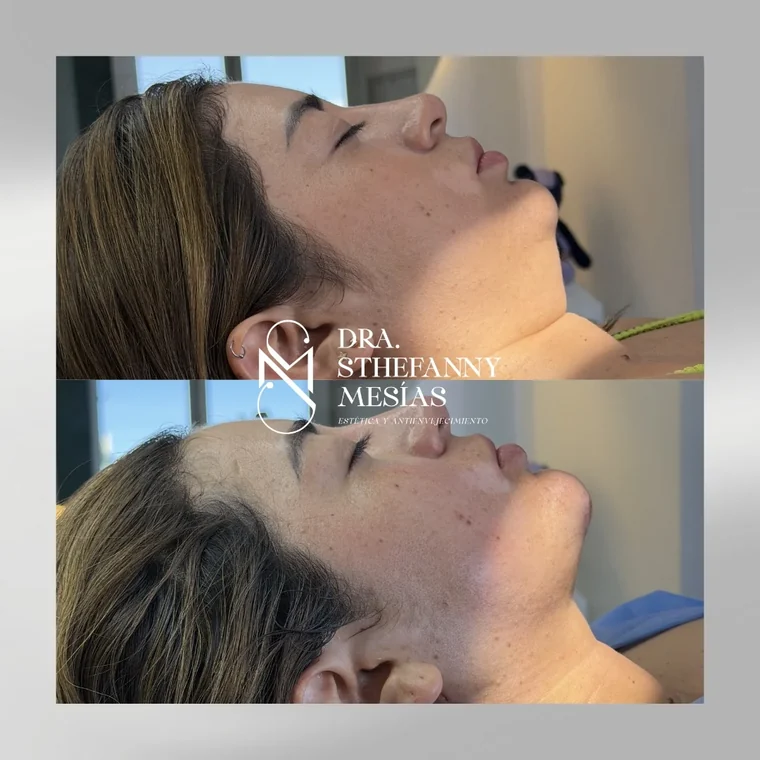 Resultado antes y después de una eliminación de lipopapada realizada por la Dra. Sthefanny Mesías en Cali, caso 3