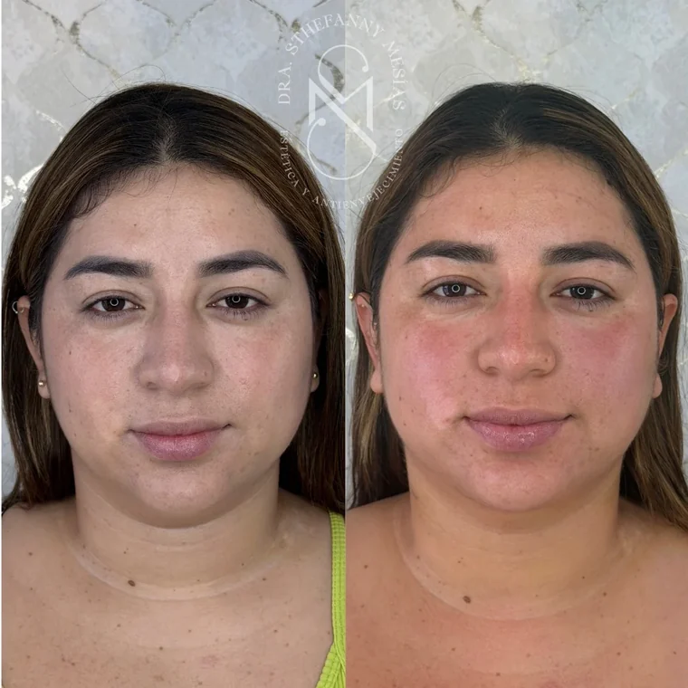 Resultado antes y después de una eliminación de lipopapada realizada por la Dra. Sthefanny Mesías en Cali, caso 4